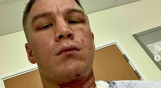 Gran Bretagna, incursione notturna a casa del campione di boxe Viktor Kotochigov: sfregiato con una sostanza acida