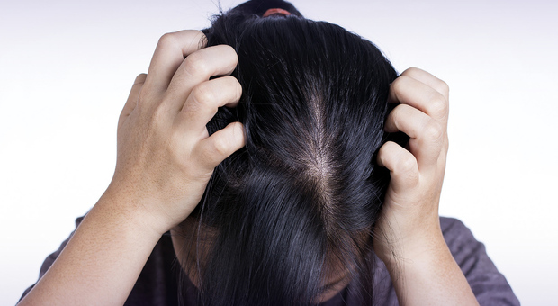 Covid, perdita di capelli tra gli effetti collaterali: ne soffre un paziente su 5 (anche tra le donne)