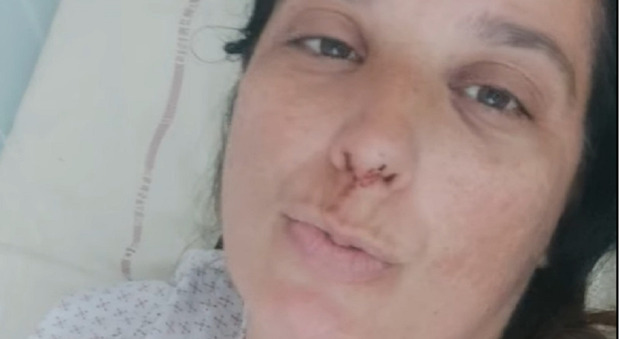 Simona Magagnin moglie di Daniele Casagrande bloccata in ospedale per le cure dopo l'incidente in moto in Francia