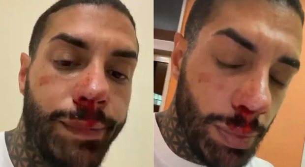 Francesco Chiofalo, viso insanguinato e naso che cola. I video dopo l'intervento fanno scoppiare la polemica: «Perché non ti pulisci?»